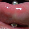 舌ピアス　腫れ